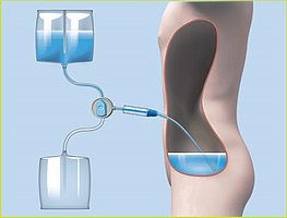 Meine Therapieoptionen | Fresenius Medical Care