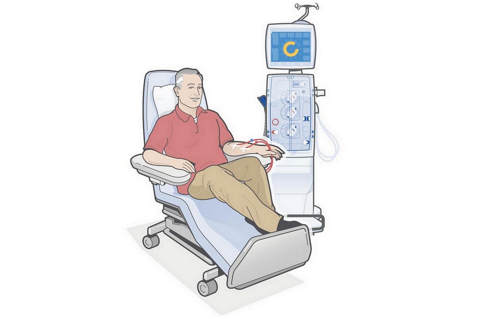 Patient bei der Hämodialyse (Zeichnung)